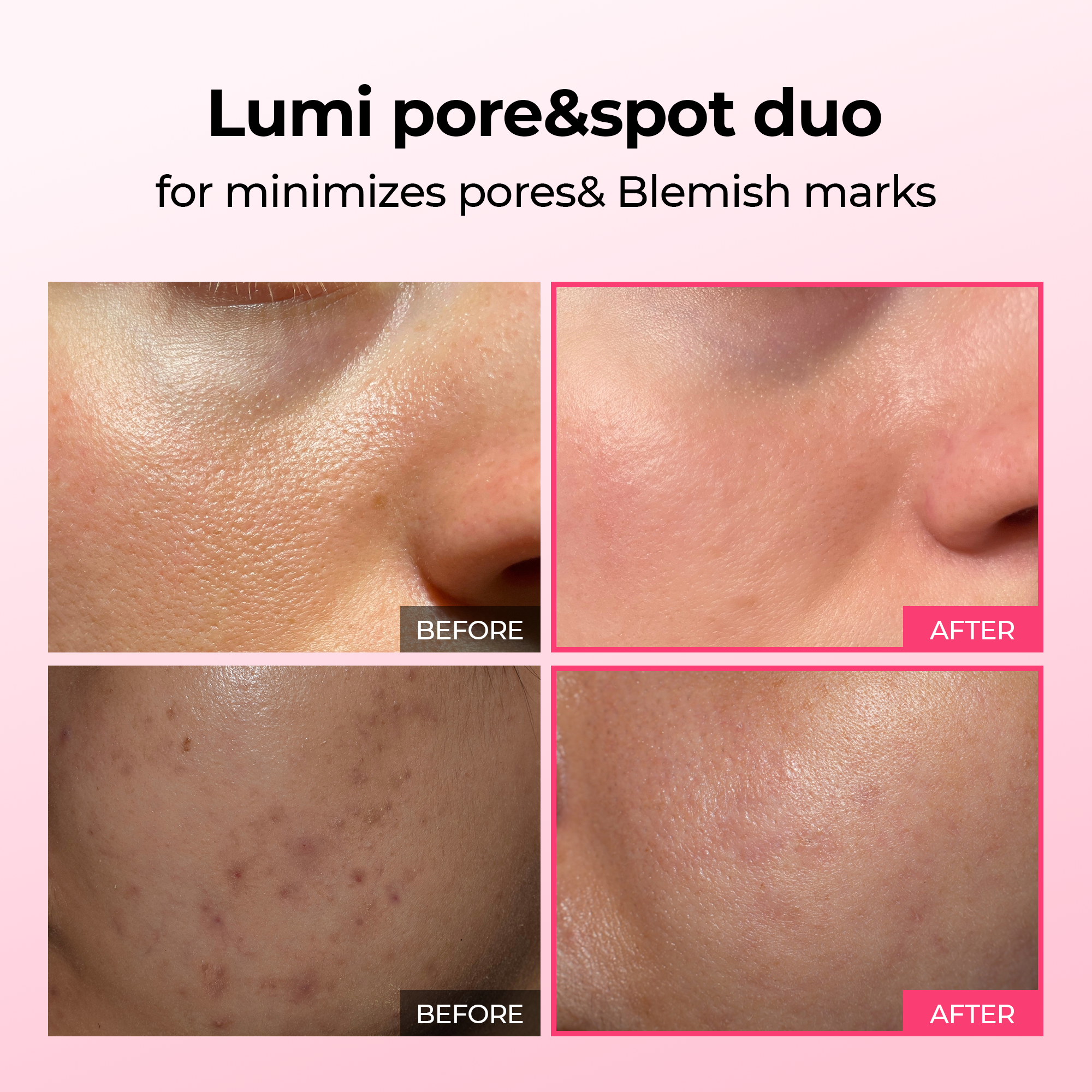 Lumi Poren- & Pickelpflege-Duo